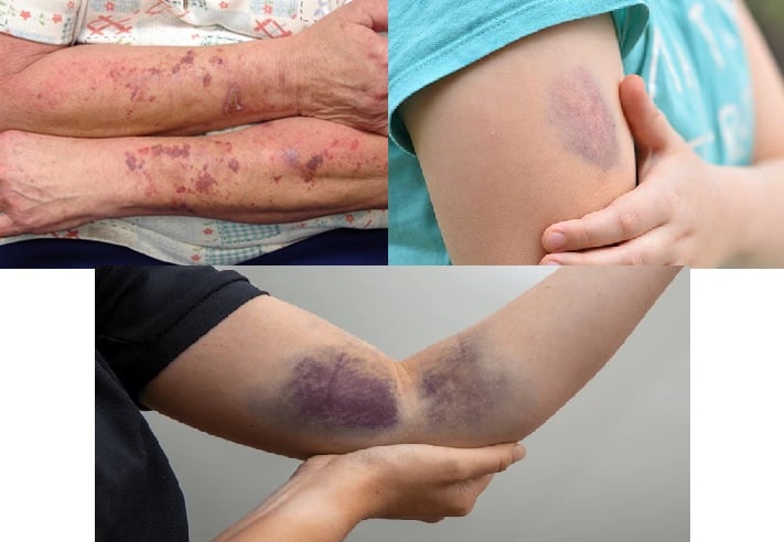 ⚠️ BE CAREFUL, if you get these bruises on your body, it means you have Ca…see more