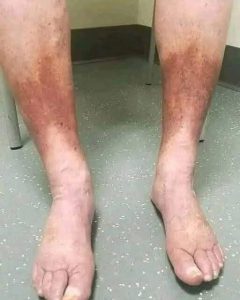 Swollen Feet: Common Causes, Warning Signs, and When to Seek Medical Advice